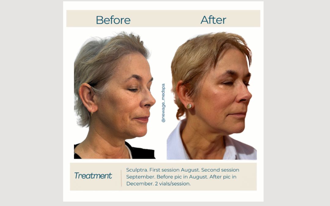Collagen Induction at New Age Medspa