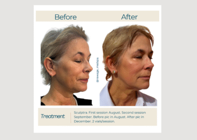Collagen Induction at New Age Medspa