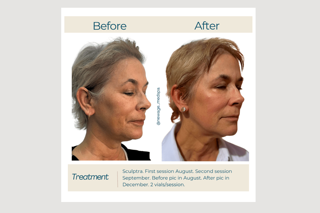 sculptra collagen building collagen building with sculptra at new age medspa