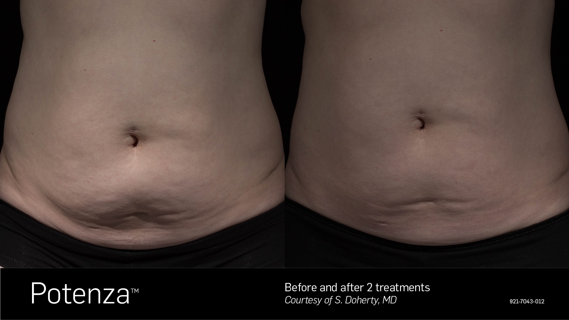 rf microneeding potenza on the stomach