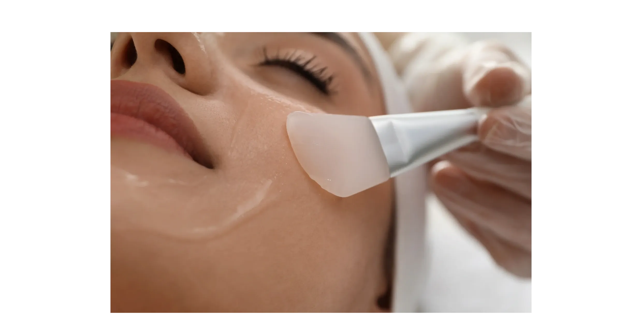 chemical peels