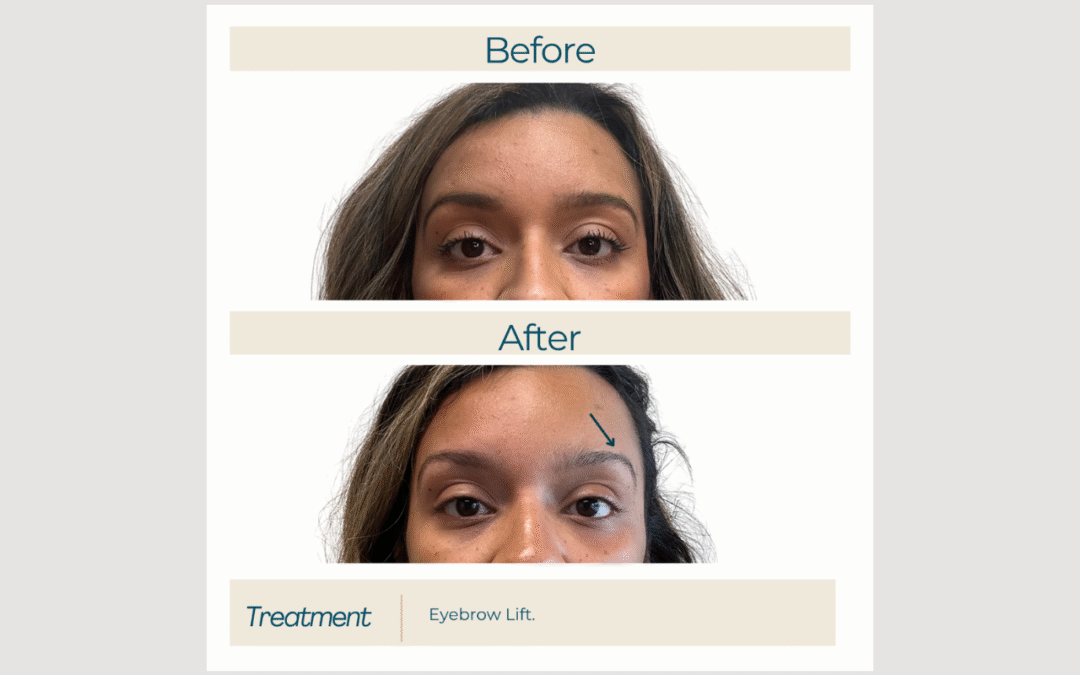 Botox for a Non-Surgical Brow Lift