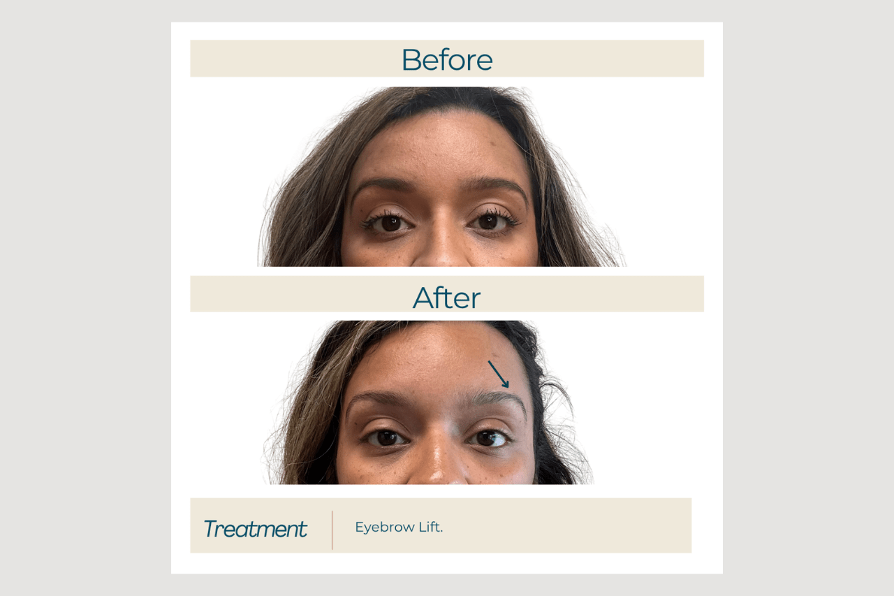 Eyebrow lift Botox eyebrow lift with botox at new age medspa in anchorage alaska
