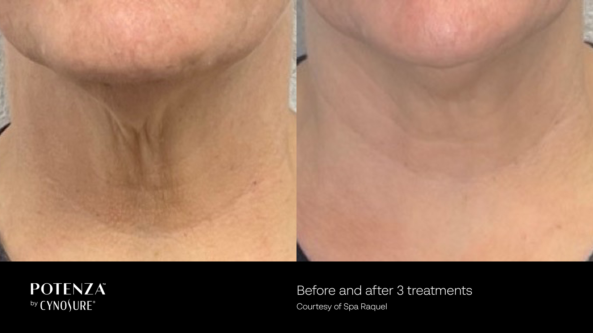 Potenza neck treatment