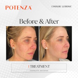 potenza rf microneedling at new age medspa in anchorage ak