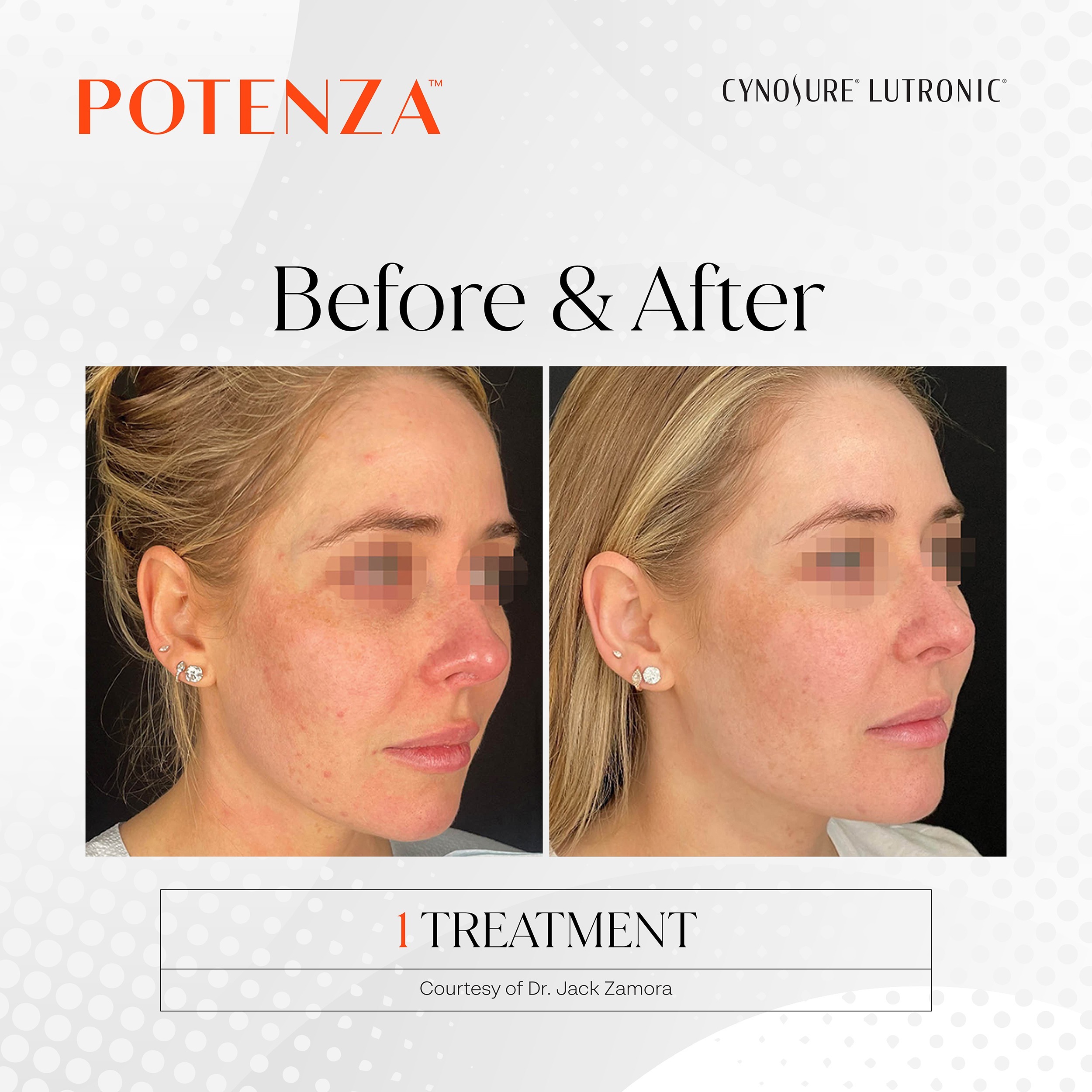 Potenza RF Microneedling Before and Afters potenza rf microneedling at new age medspa in anchorage ak