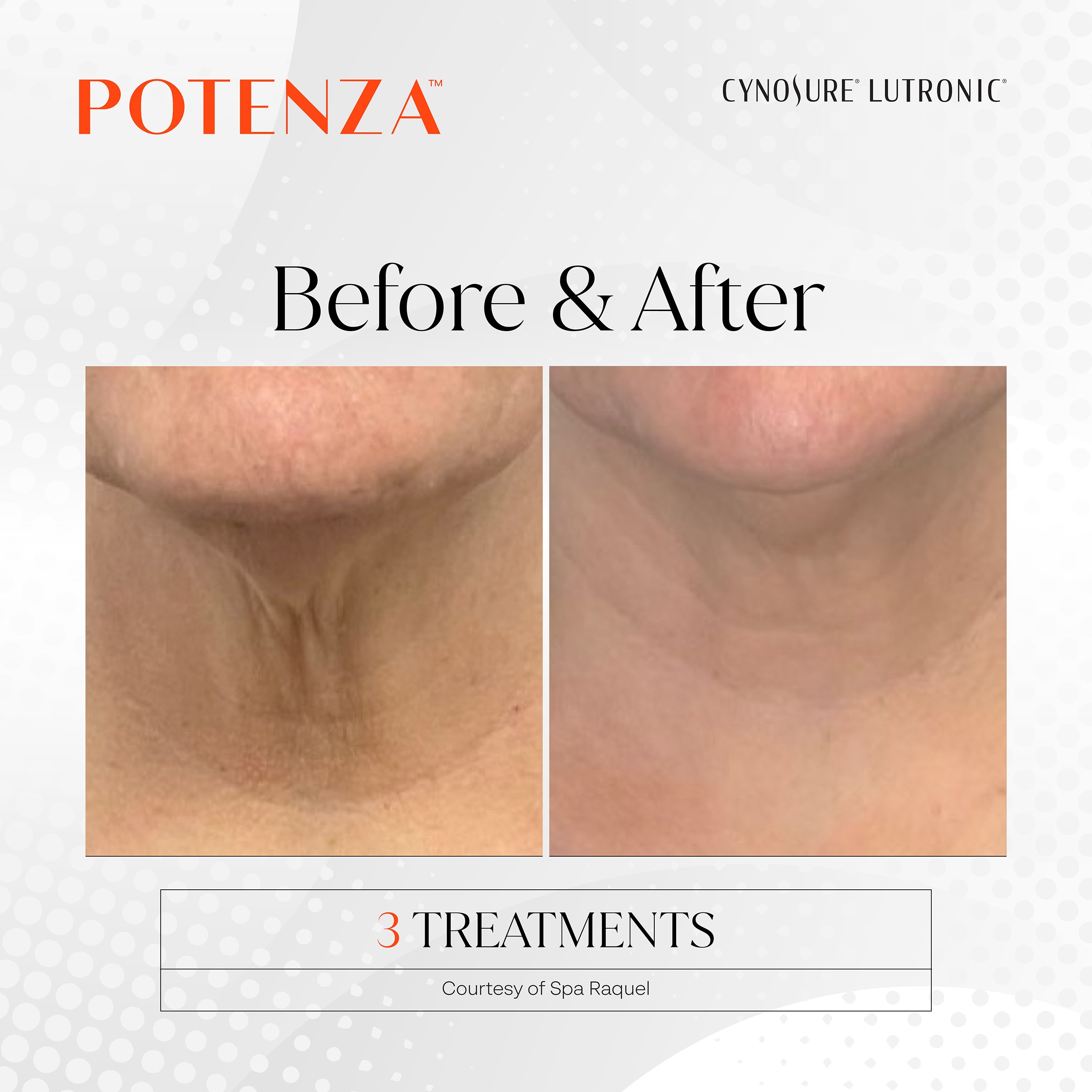Best RF Microneedling System Potenza RF Microneedling for the next at new age medspa in alaska ak