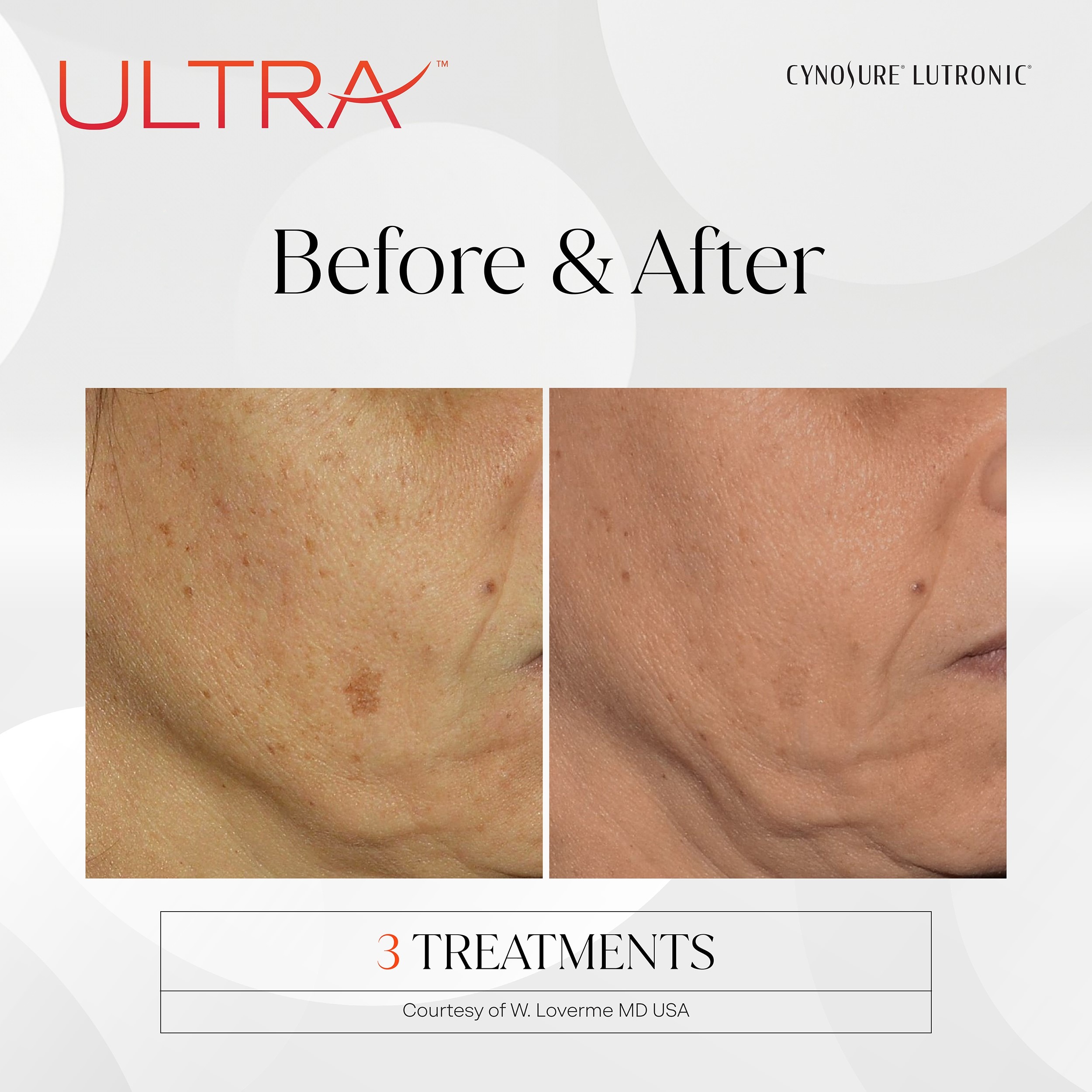 PRD-1656-LaseMD-Ultra_BNA-3 ultra laser before and after at new age medspa in anchorage alaska for skin pigmentation