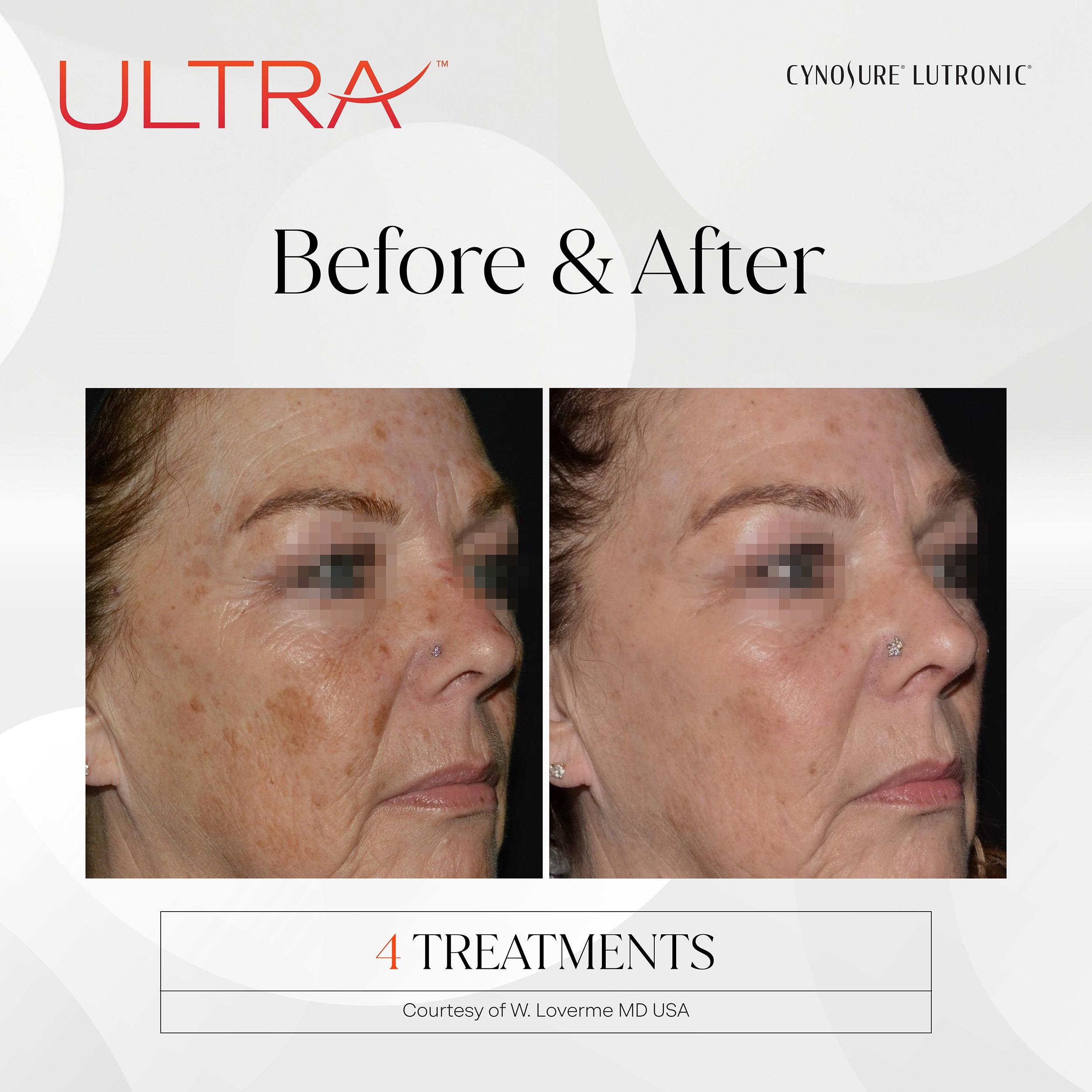 PRD-1656-LaseMD-Ultra_BNA-4 ultra laser cynosure to smooth lines and wrinkles