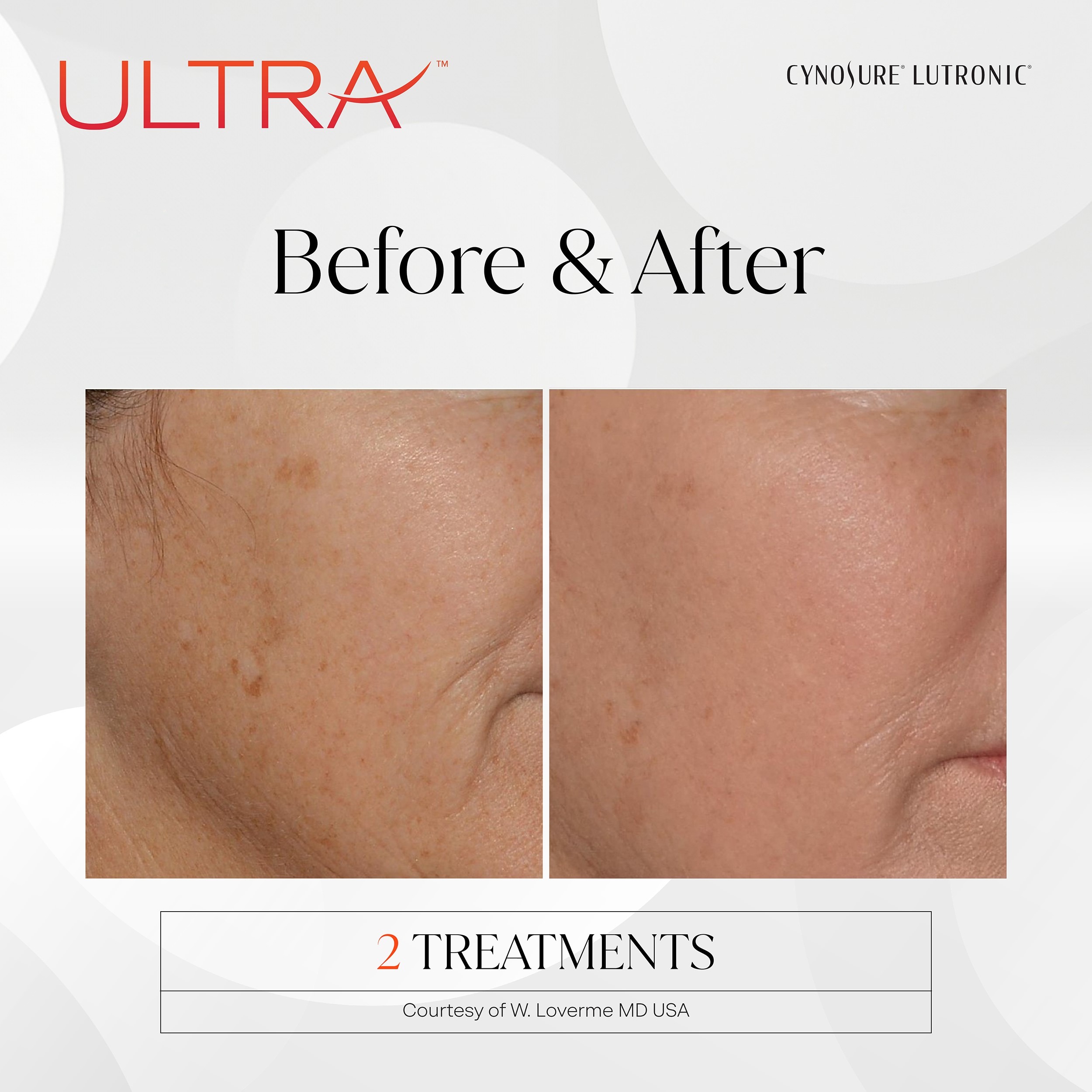 before and after laser treatments at new age medspa in anchorage ak