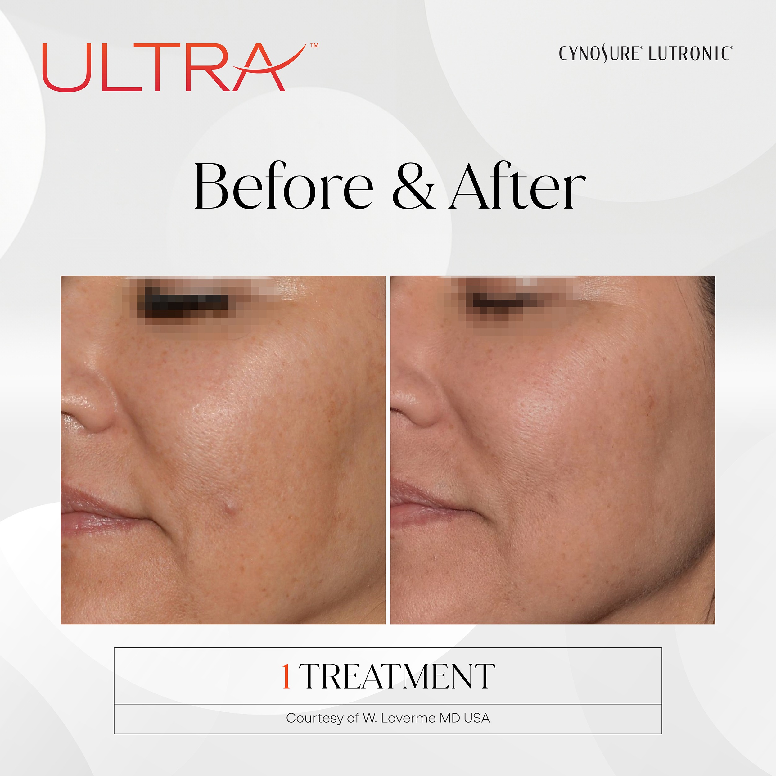 ultra laser treatments in anchorage ak