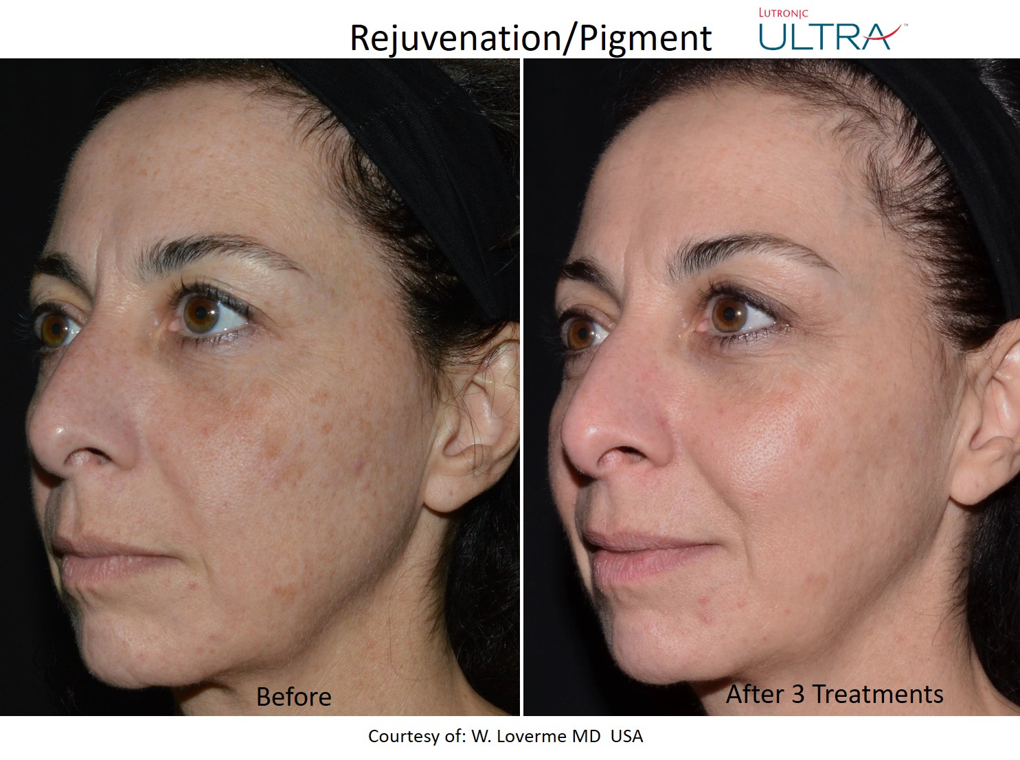 Ultra Loverme Rejuvenation Pigment 4 Left lasemdbeforeandafter