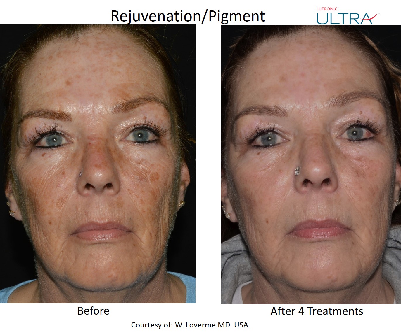 Ultra Loverme Rejuvenation Pigment 5 Frontal lasermd<br />