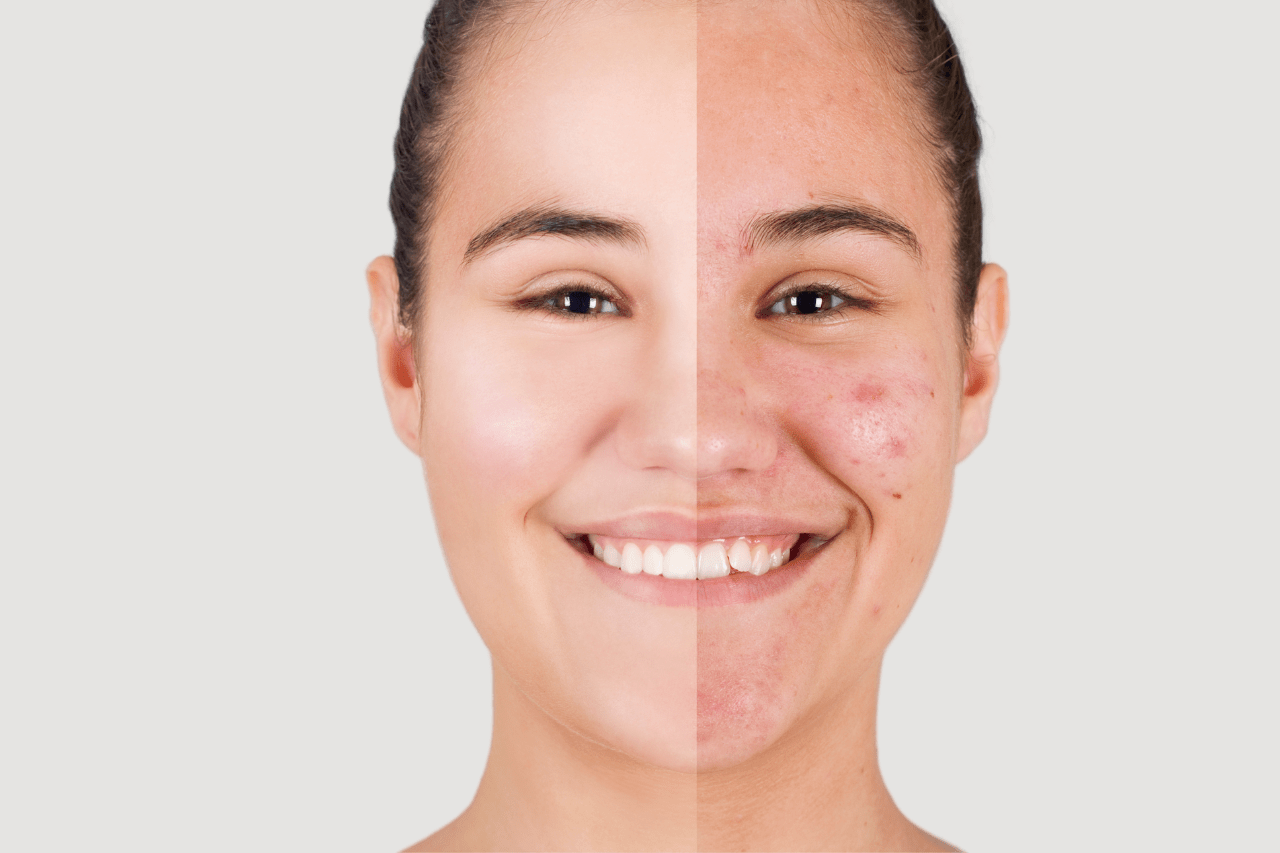 get clearer skin at new age medspa in anchorage alaska