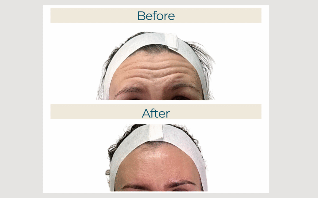 Wrinkle Reducers