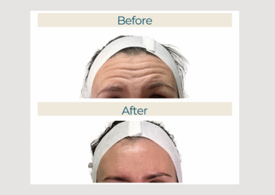 Wrinkle Reducers
