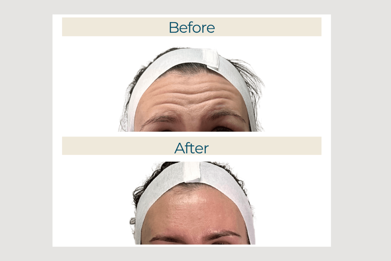 botox before and after (1)