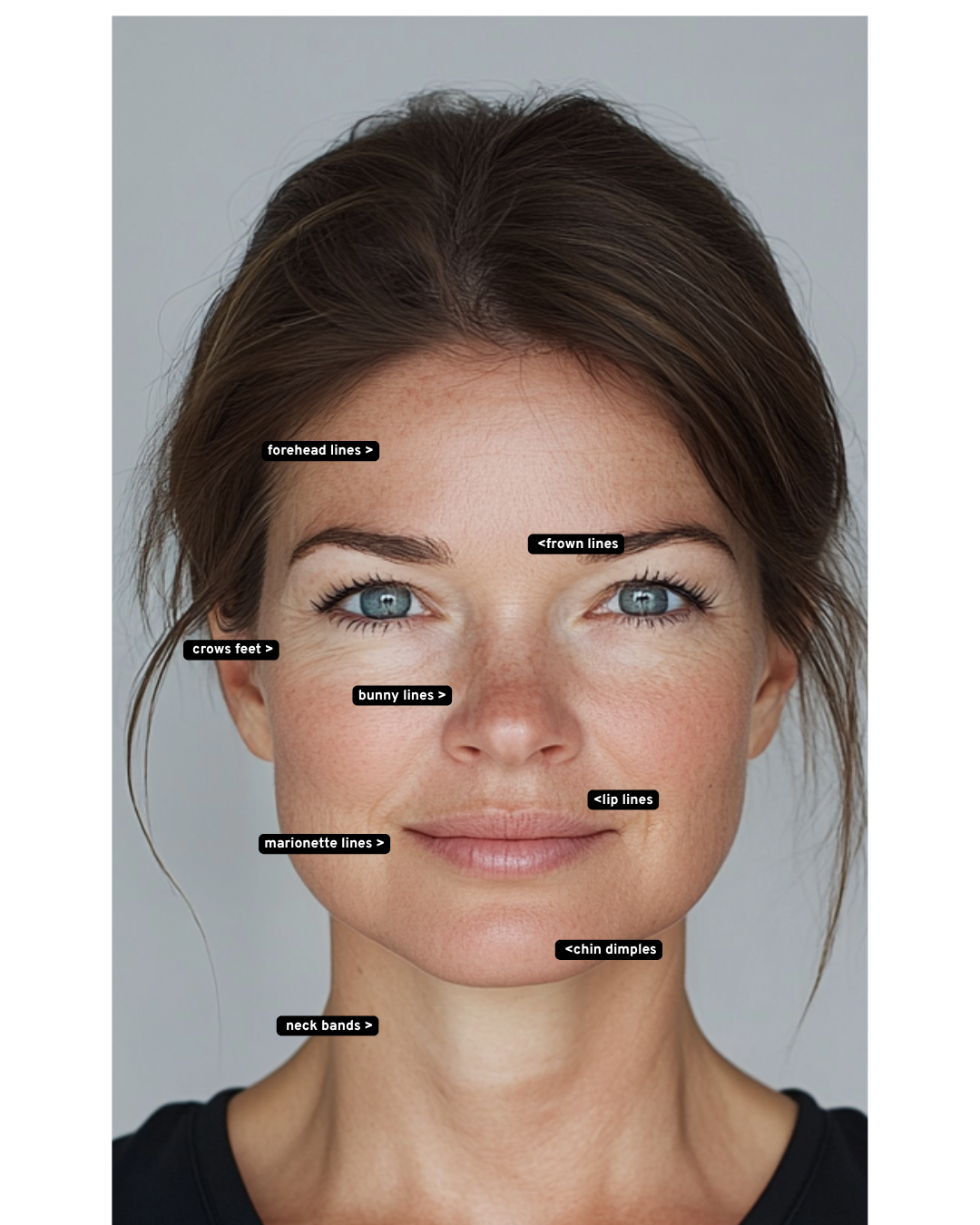 botox placement (1) botox before and after