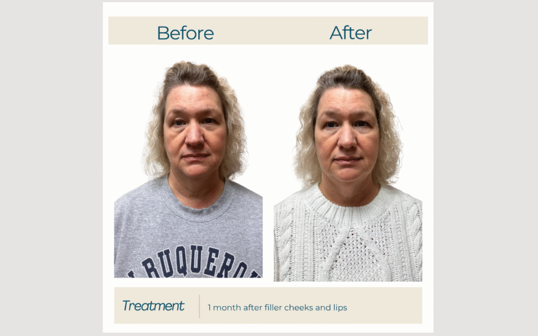 Cheek + Lip Filler for Facial Balance