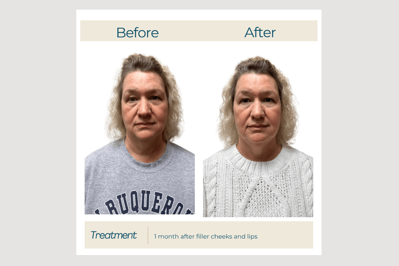 cheeklipfiller cheek and lip filler at new age medspa in anchorage alaska