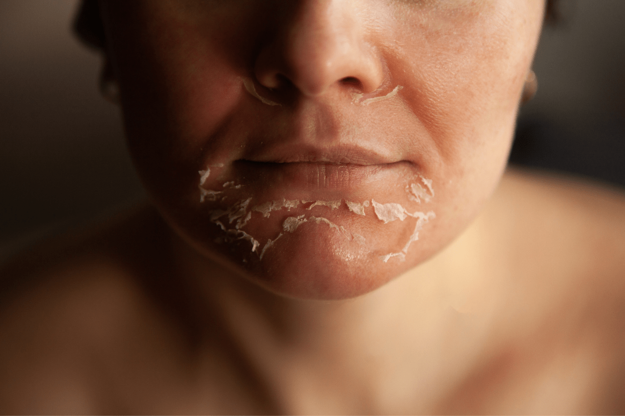chemical peels at new age medspa in anchorage alaska