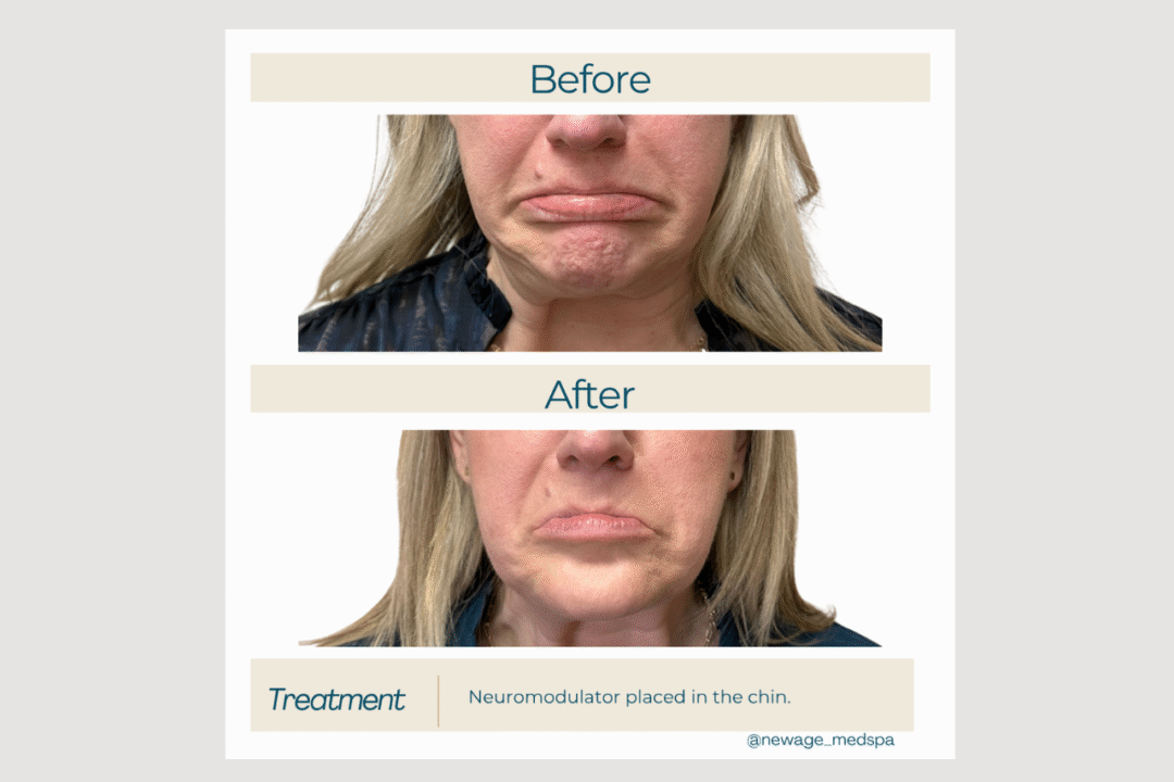 Daxxify for Chin Line Refinement
