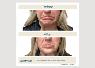 Daxxify for Chin Line Refinement
