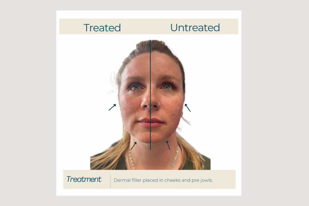 Cheek + Pre-Jowl