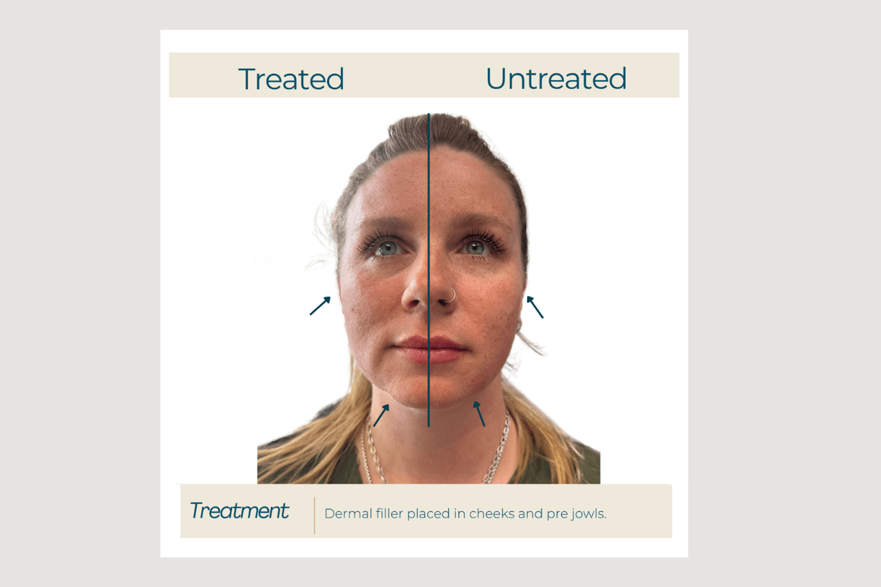 dermal filler cheeks and jowls cheek and pre jowl filler in anchorage ak