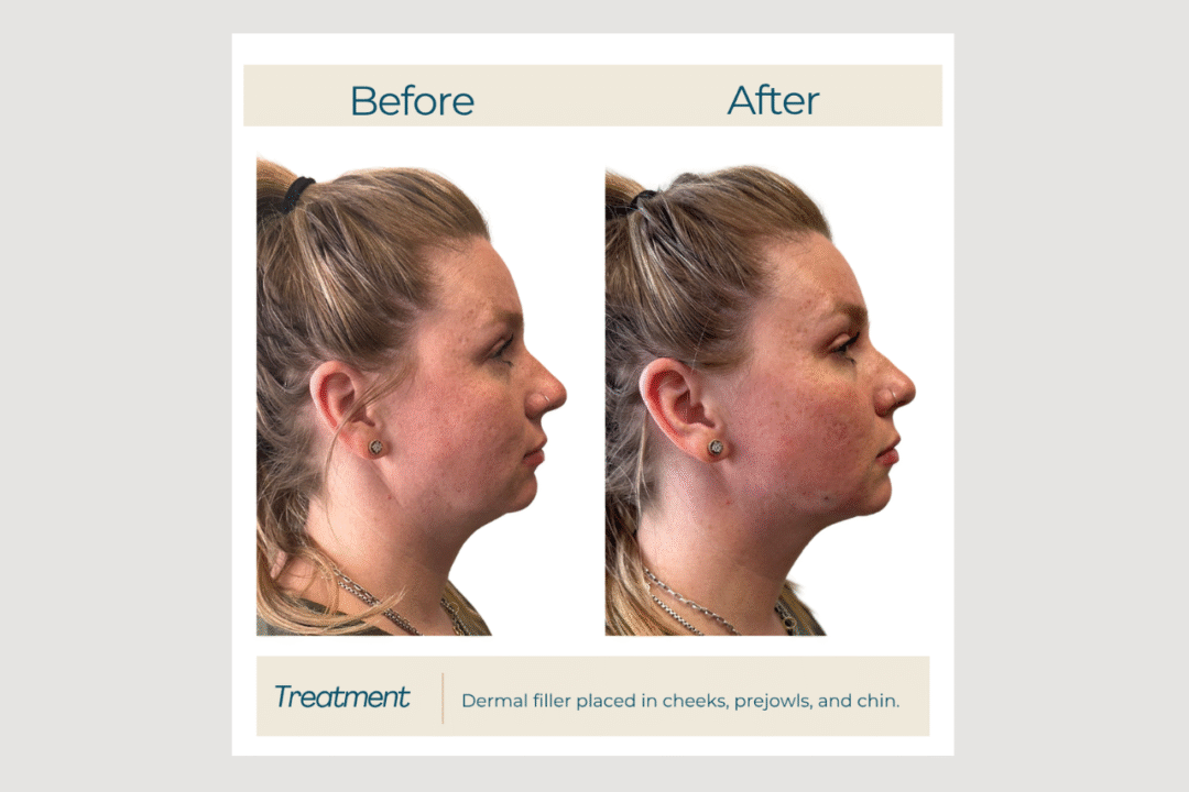 Profile Contour