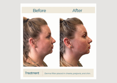 Profile Contour