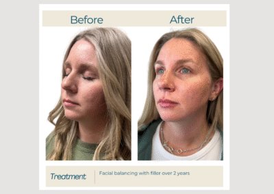 Facial Balancing