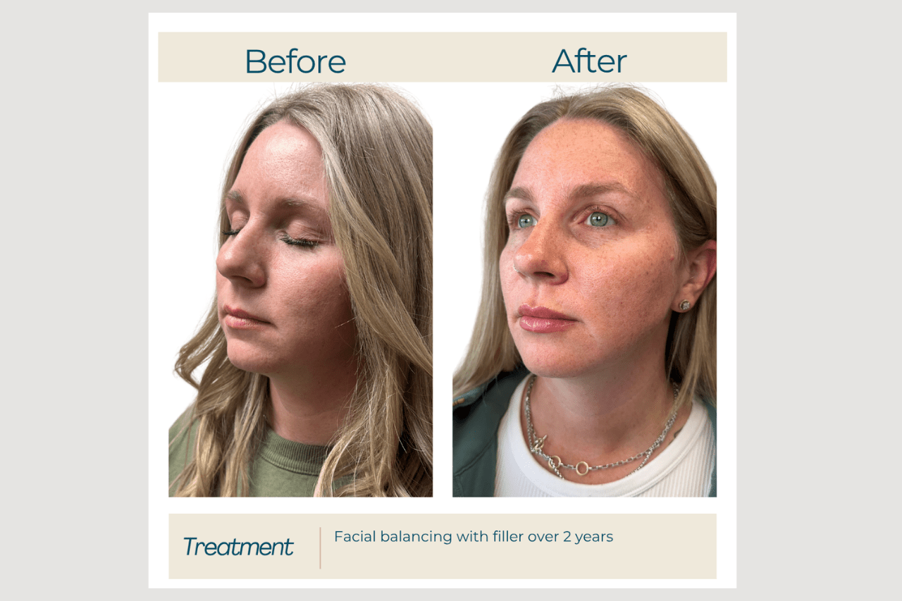facial balancing with fillers at new age medspa in anchorage ak