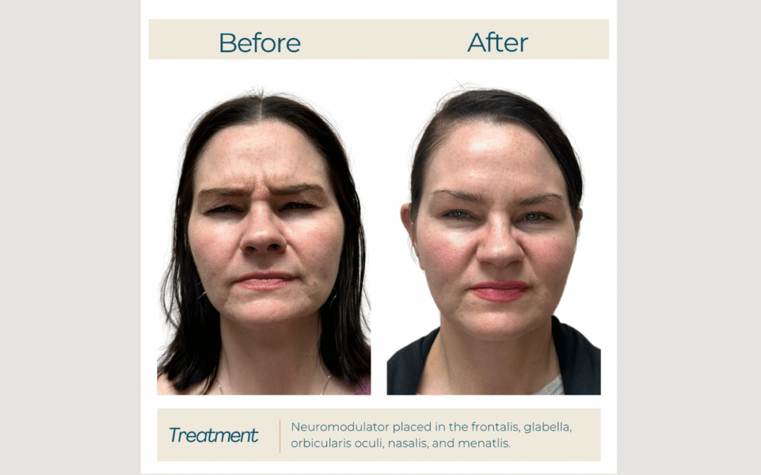 Full-Face Refinement