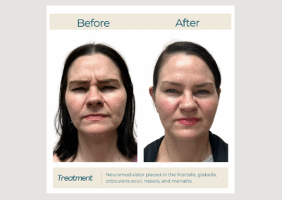 Full-Face Refinement