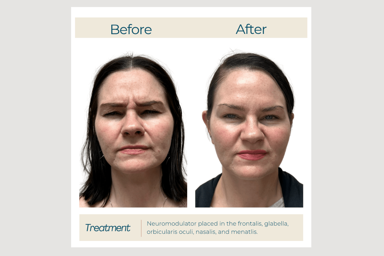 full face dysport full face refinement with dysport