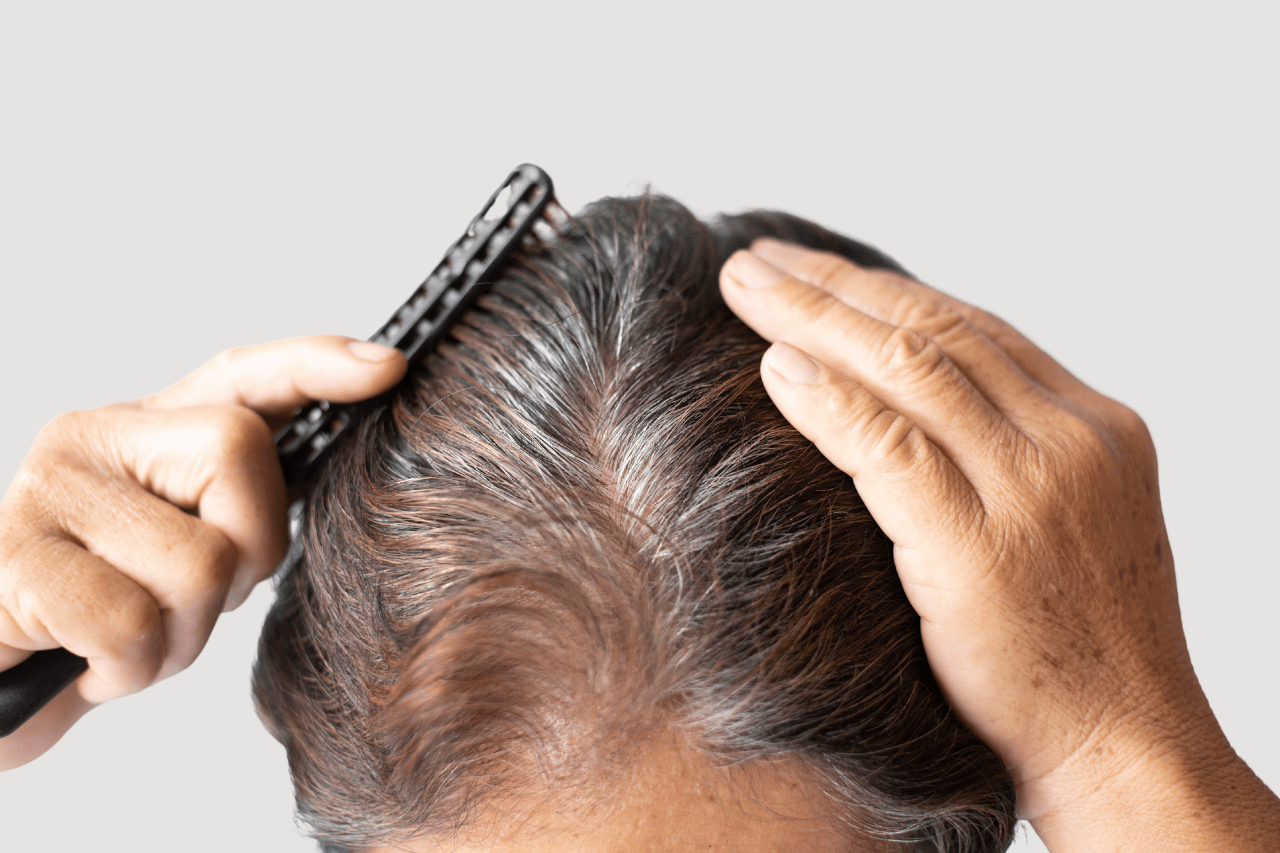 non injection laser hair restoration