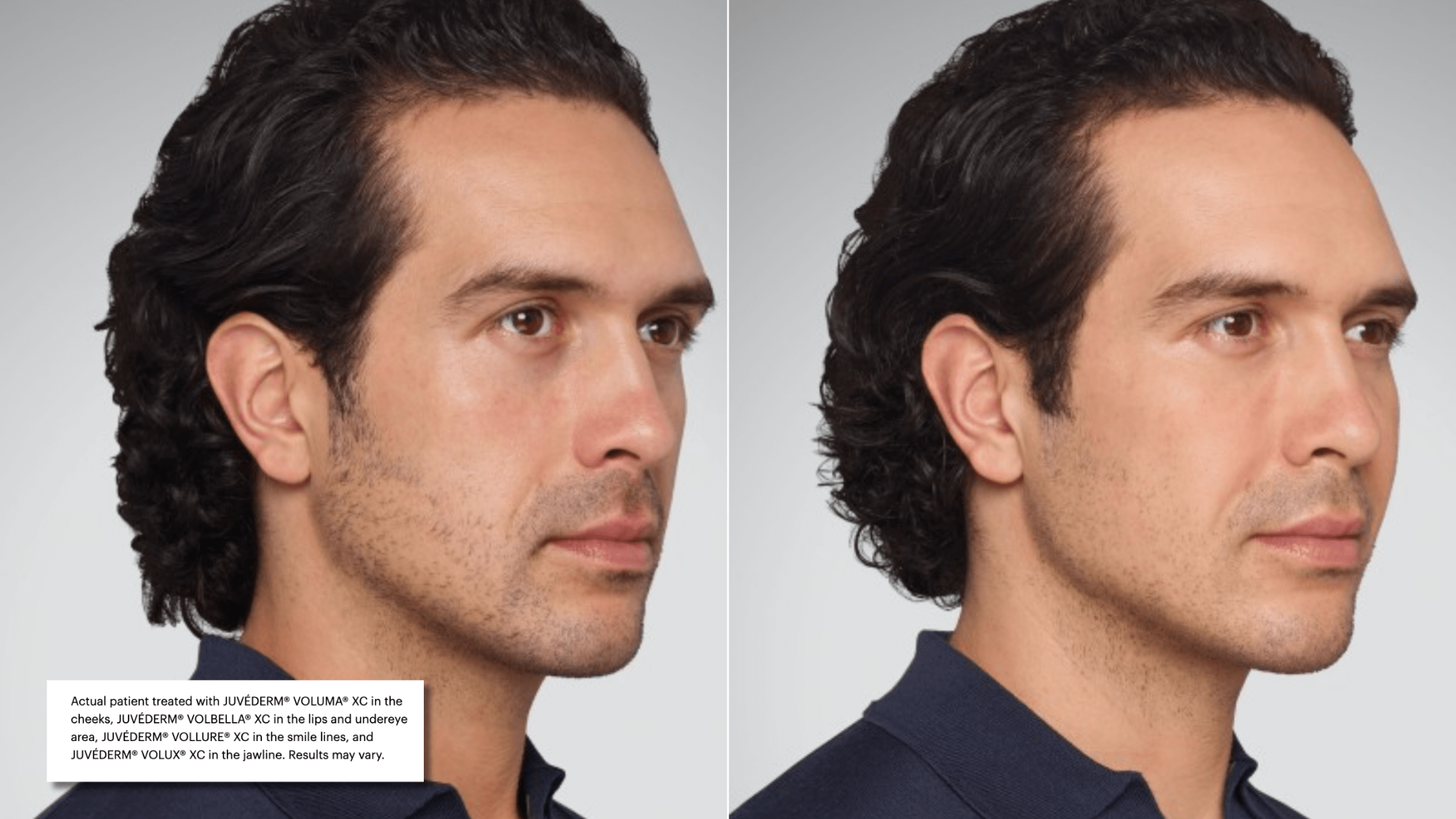 jawline filler male male jawline before and after