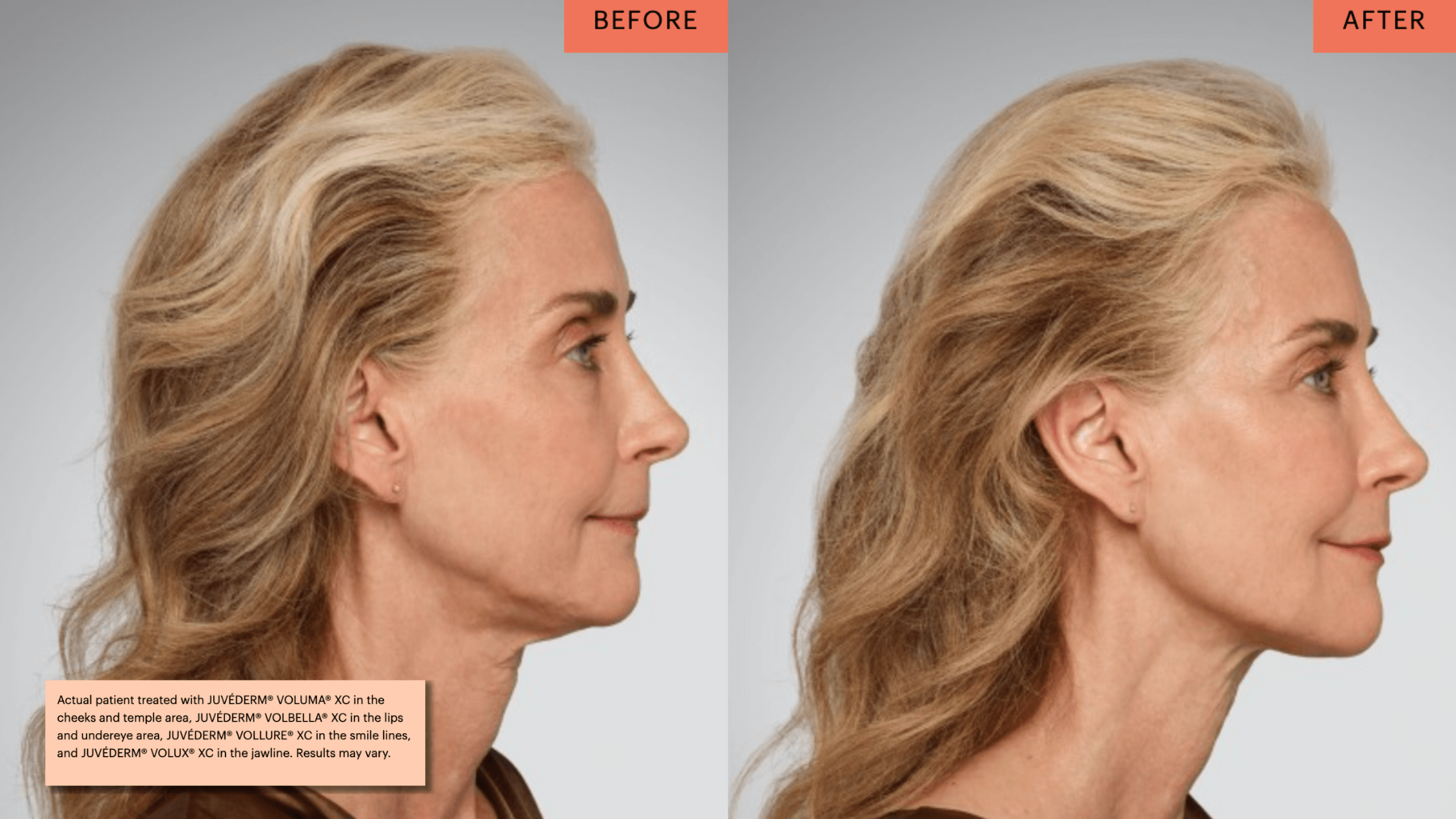 jawline filler before and after jawline filler.