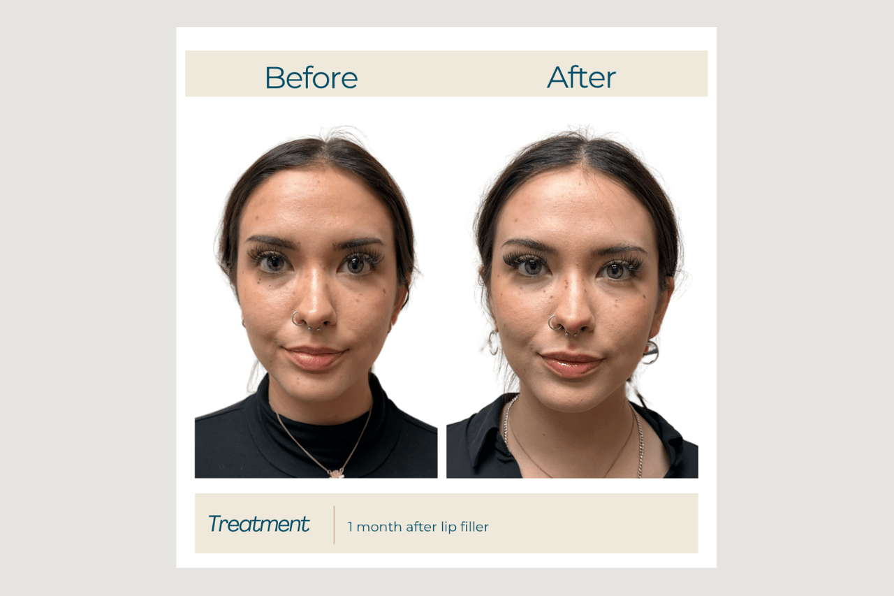 lip filler one syringe lip filler natural look at new age medspa