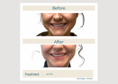Lip Flip with Botox