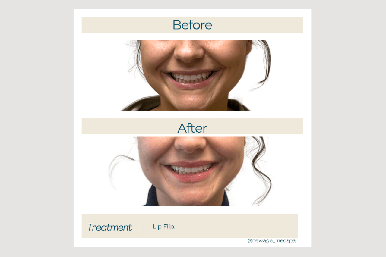 lip flip lip flip at new age medspa in anchorage ak
