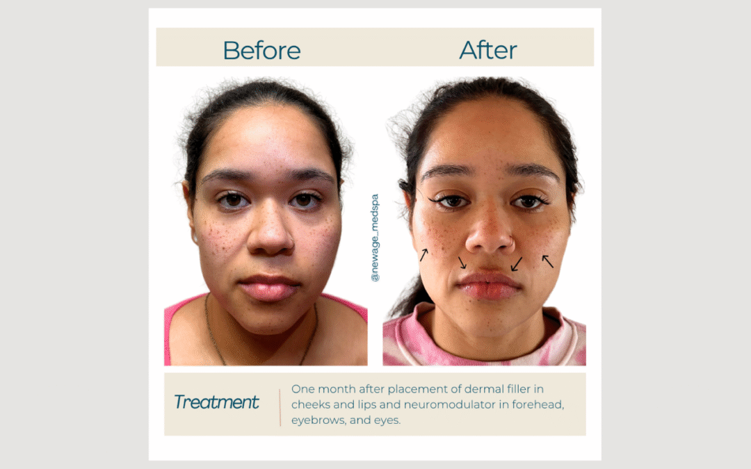 Upper-to-Lower Lip Balance