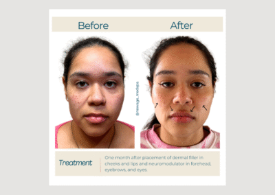 Upper-to-Lower Lip Balance