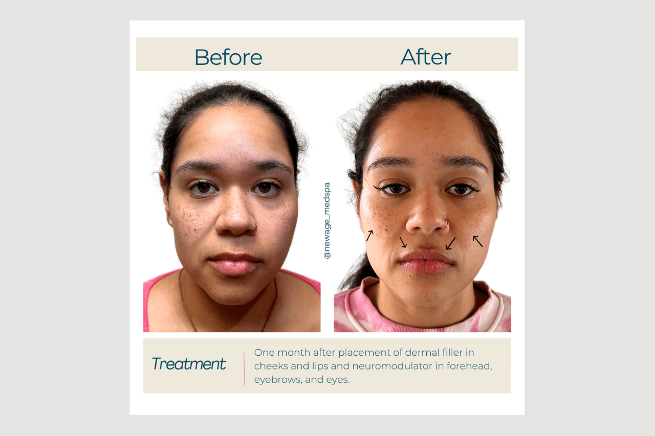 lips, cheeks, botox lip, cheek filler and botox in anchorage ak