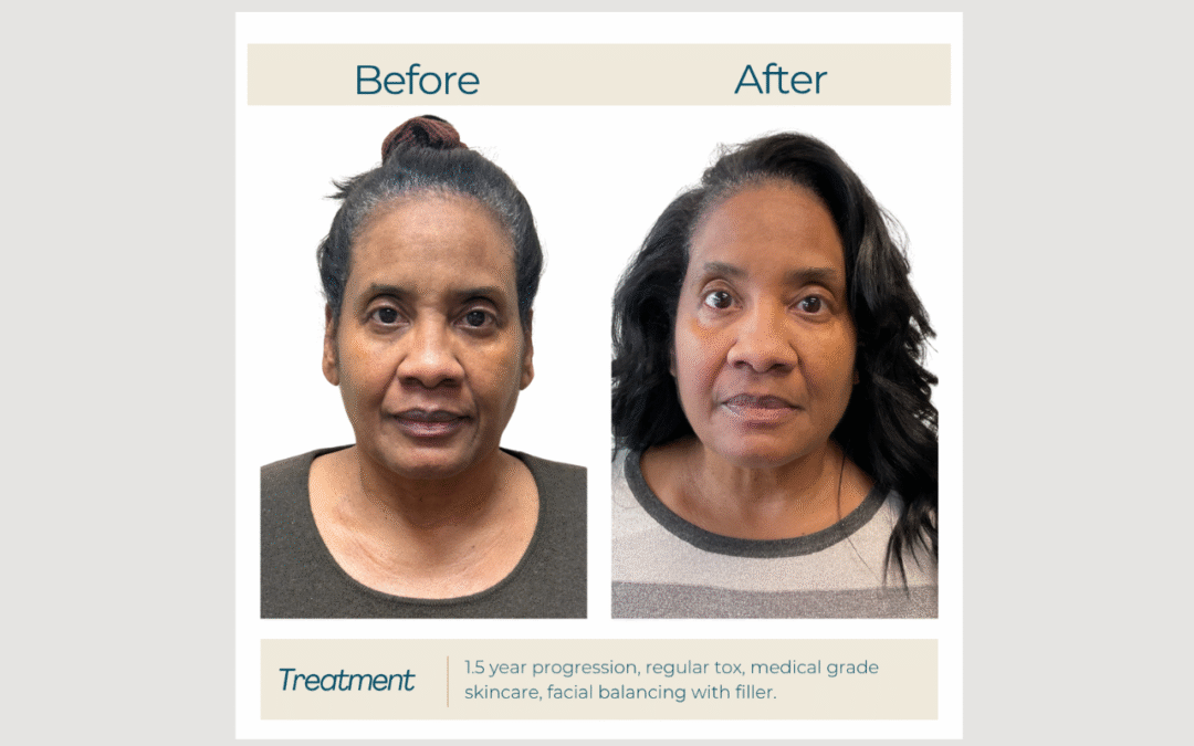 Smoother, More Even Skin