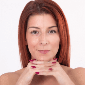 Botox and SkinPen microneedling PFD special at New Age Medspa in Anchorage
