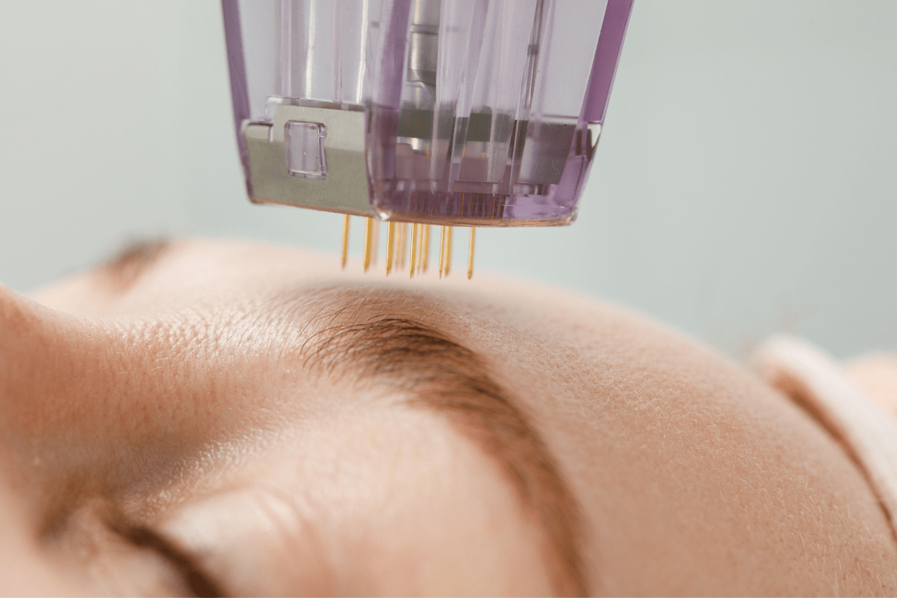 rf microneedling in acc
