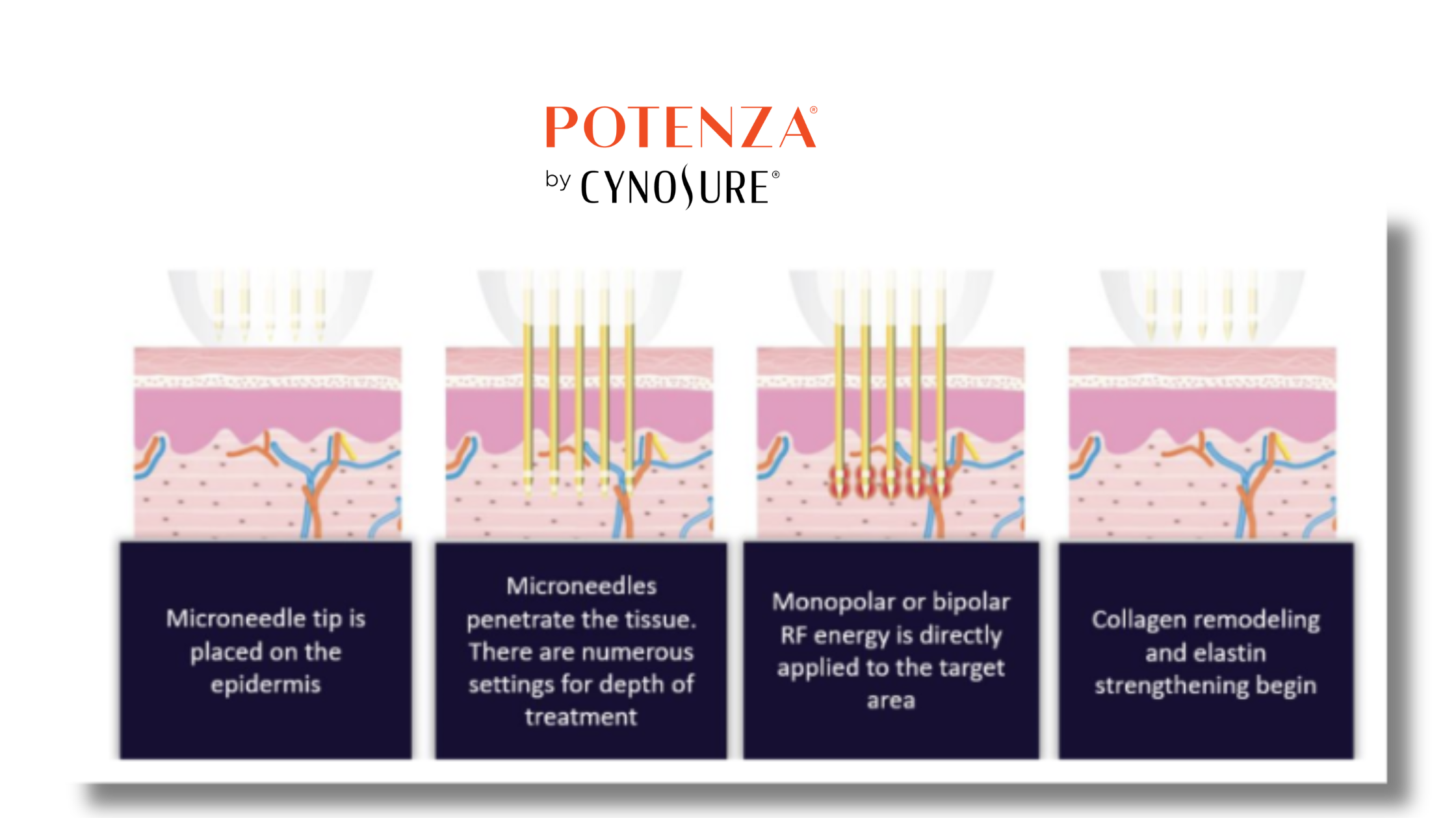 how microneedling works