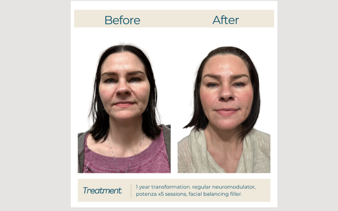 Potenza RF Microneedling